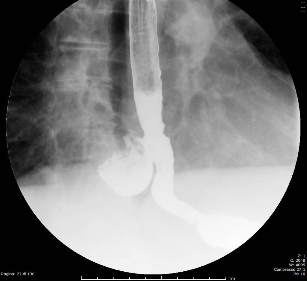 Trattamento robotico di diverticolo esofageo epifrenico